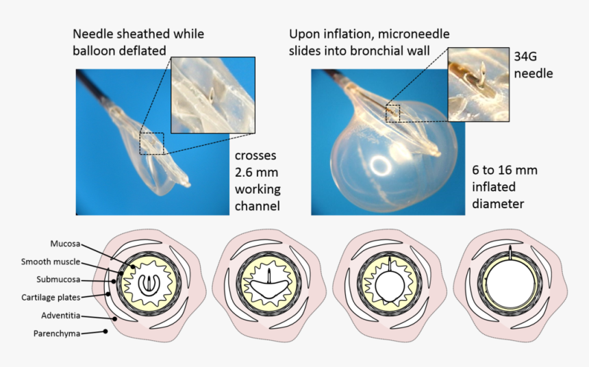 Bullfrog Microinfusion Device, HD Png Download