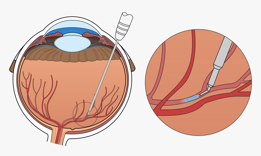 Robot-tekening - Central Retinal Vein Occlusion Injection, HD Png Download