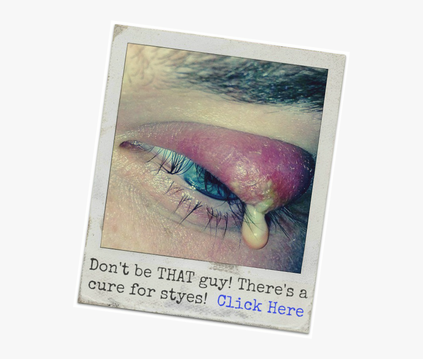 Eyeballs Clipart Blood - Keep Getting Styes, HD Png Download