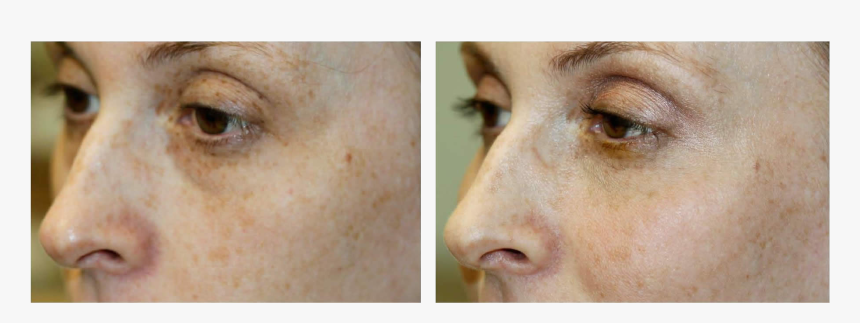 Dermal Filler - Freckle, HD Png Download