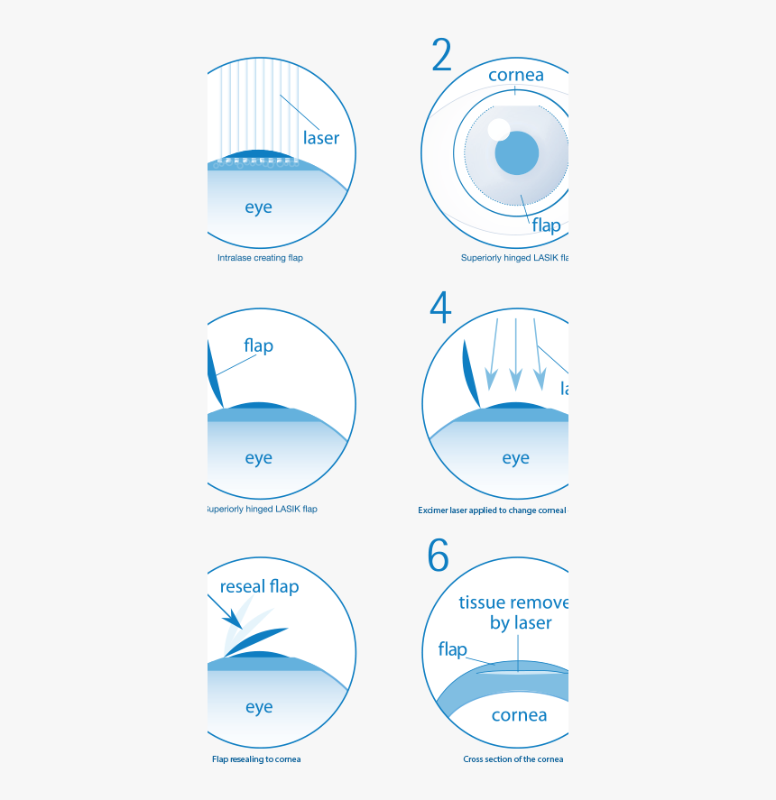 Transparent Procedure Png - Eye Laser Surgery Steps, Png Download
