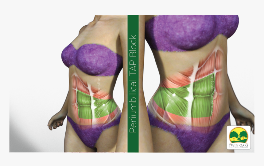 Periumbilical Tap, HD Png Download