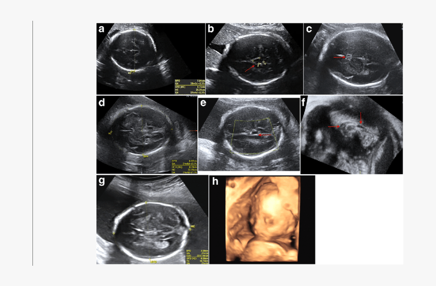 Bpd On An Ultrasound, HD Png Download
