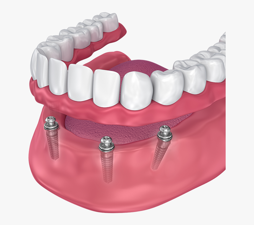 All On 4 Lower Denture - Implant Supported Denture, HD Png Download