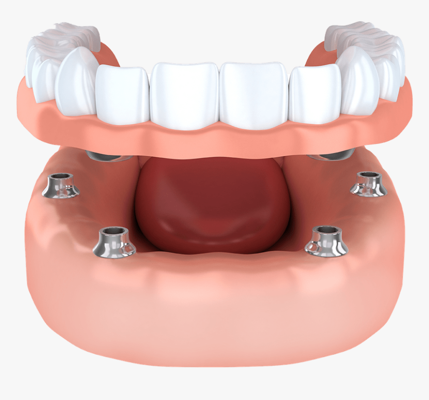 Implant Supported Model Brownstown, Mi - Snap Dentures, HD Png Download