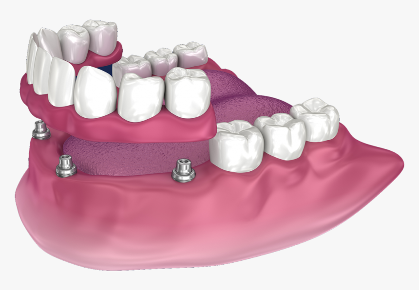 Snap On Dentures In San Diego - Full Denture With Precision Attachments, HD Png Download
