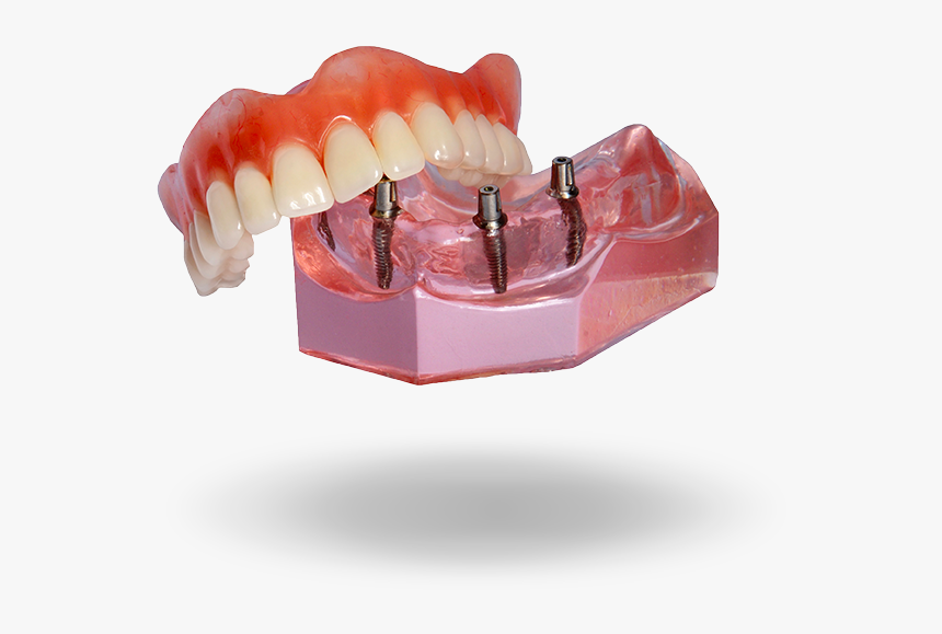 Implant Denture Model Hixson,tn - Permanent Implant Dentures, HD Png Download