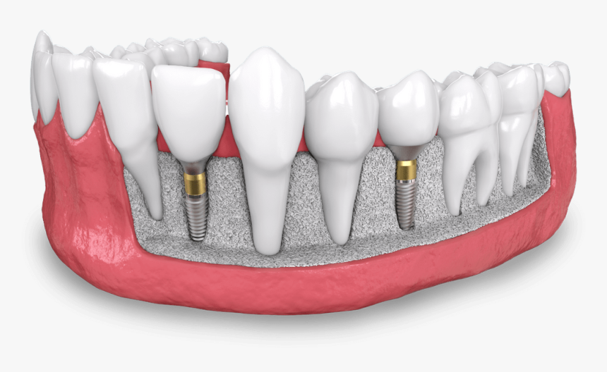 Dental Implant Model Dana Point Ca - Dental Implant, HD Png Download