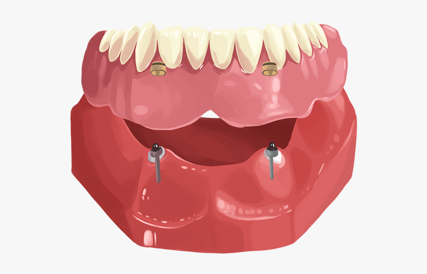Dentures, HD Png Download
