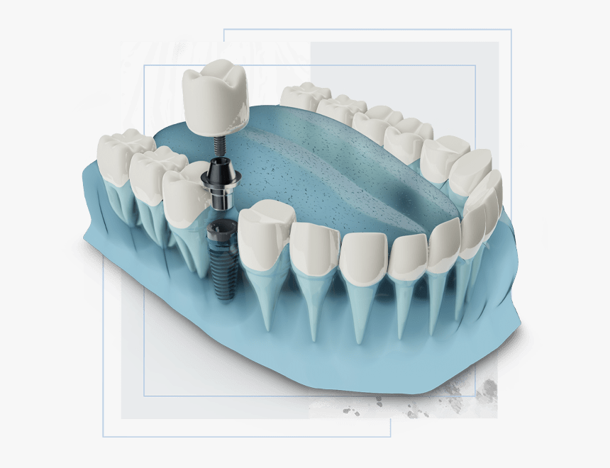 Dental Implants Graphic - Dental Implant, HD Png Download