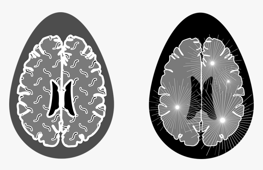Stwardnienie Rozsiane Skąd Sie Bierze, HD Png Download