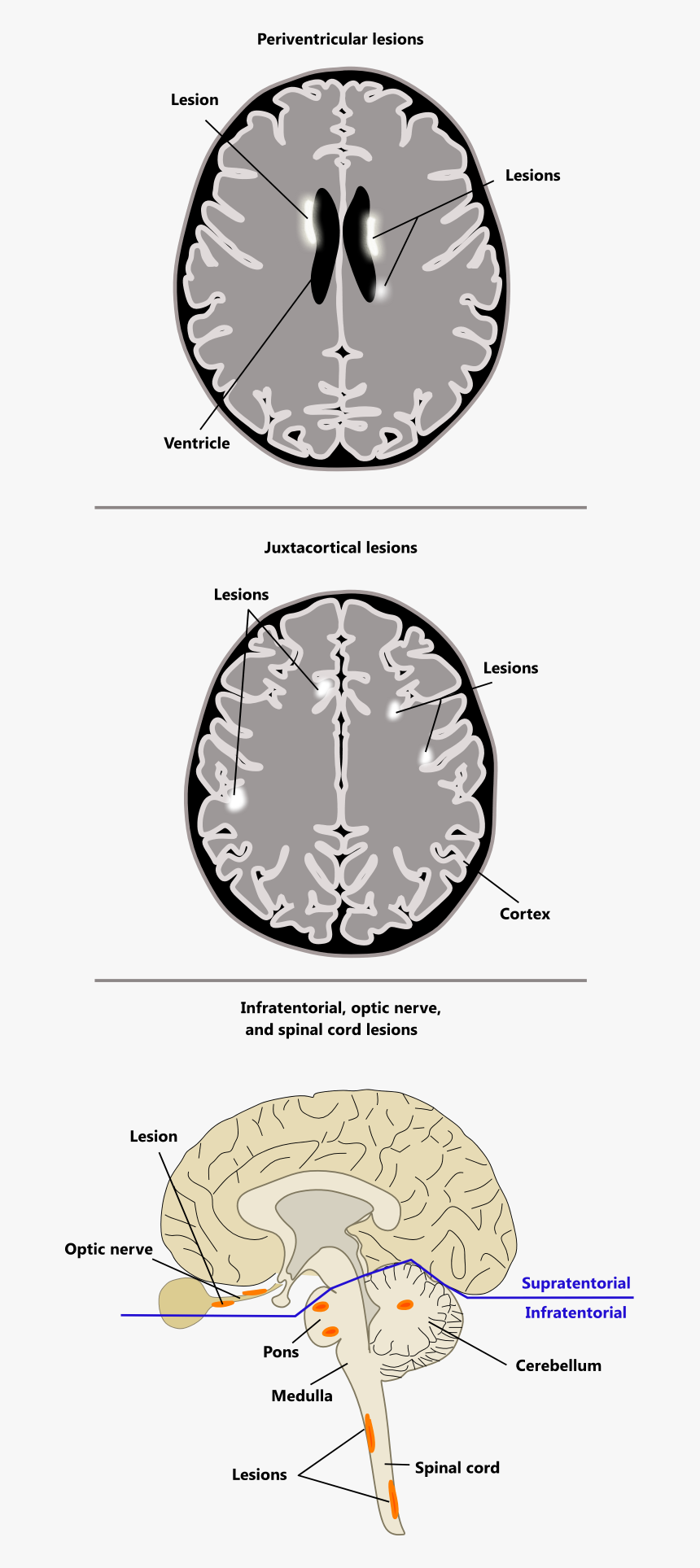 Periventricular Juxtacortical Infratentorial Spinal, HD Png Download