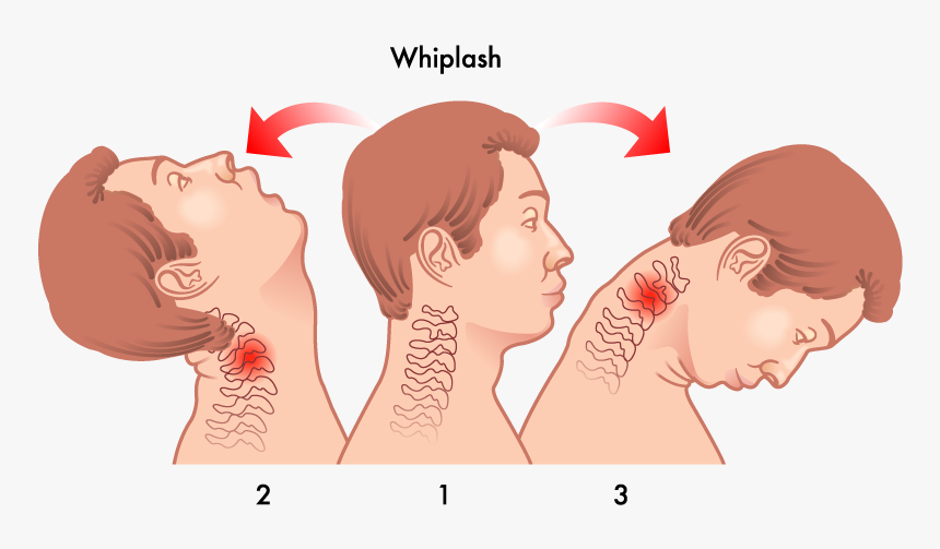 Head Neck Whiplash - Whiplash Injury, HD Png Download