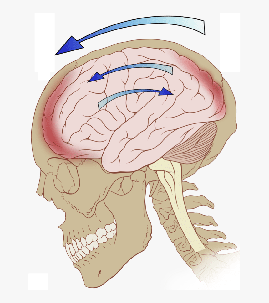 Concussion, Whiplash & Migraine Related Injuries - Primary Brain Injury, HD Png Download