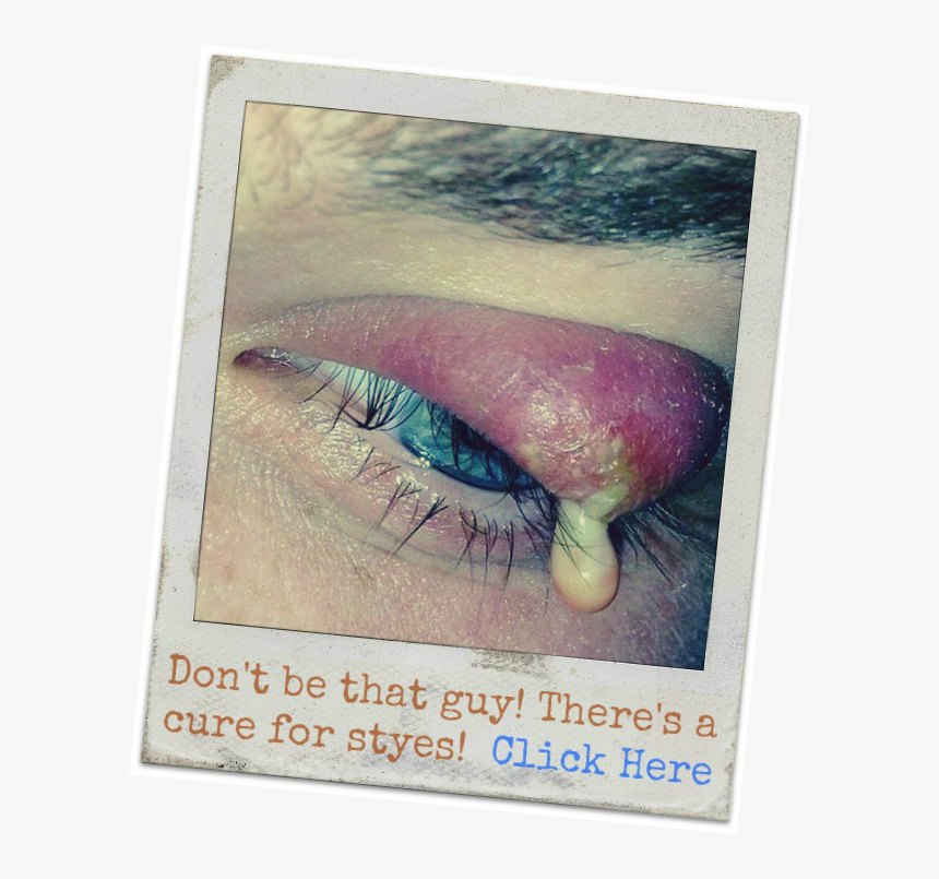 Does Putting A Tea Bag On Eyes Get Rid Of Styes Warm Compress, HD Png