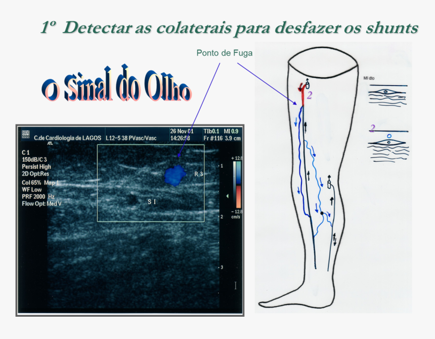 Ecodoppler Venoso Dos Membros Inferiores, HD Png Download
