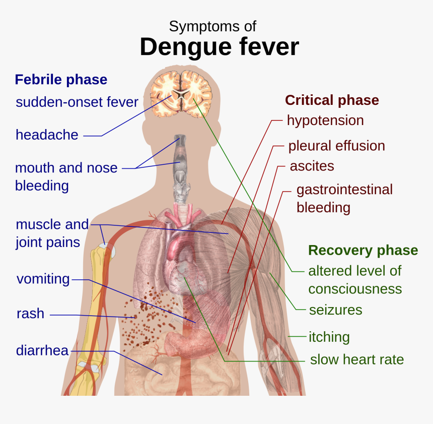 Dengue Fever Symptom, HD Png Download