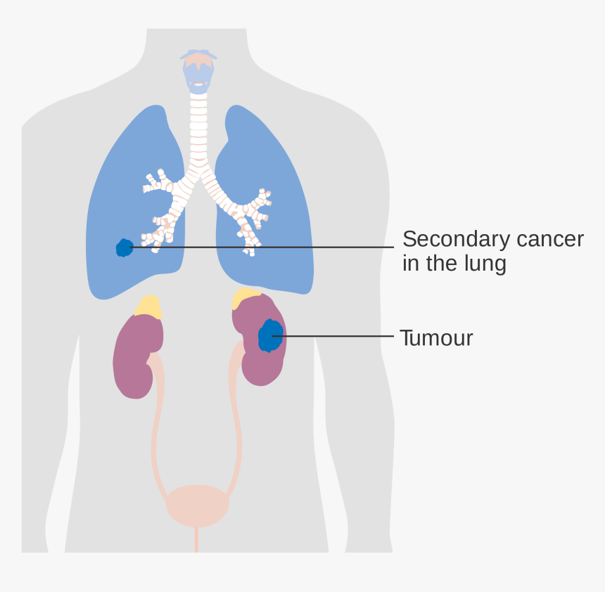 Kidneys Png , Png Download - Secondary Lung Tumor, Transparent Png