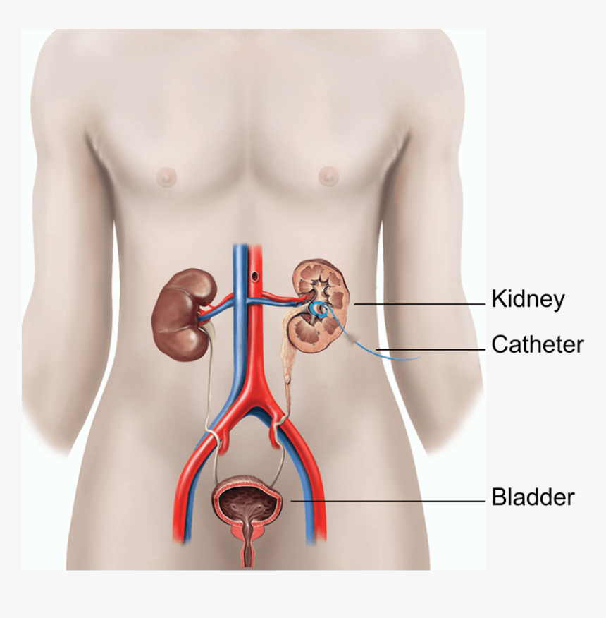 Illustration Showing A Nephrostomy - Kidney Catheter, HD Png Download