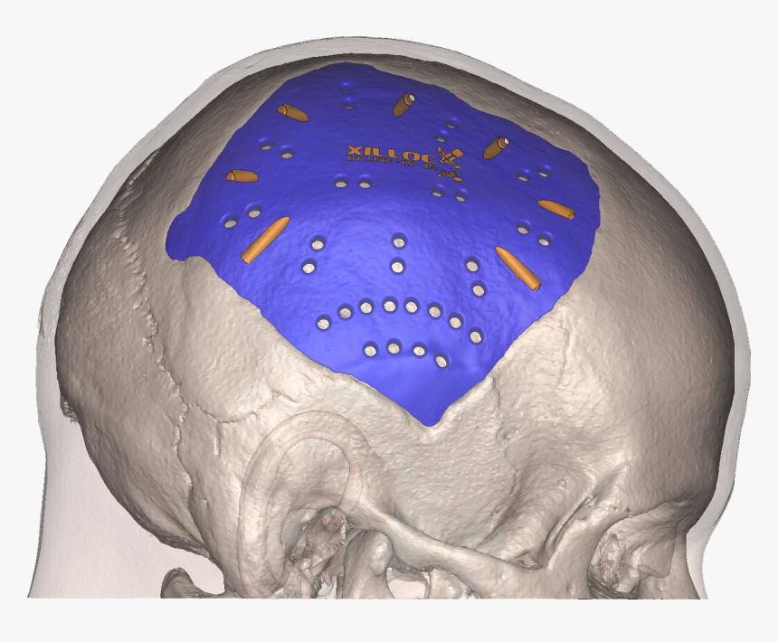 With Patient-specific Implant - Hippopotamus, HD Png Download
