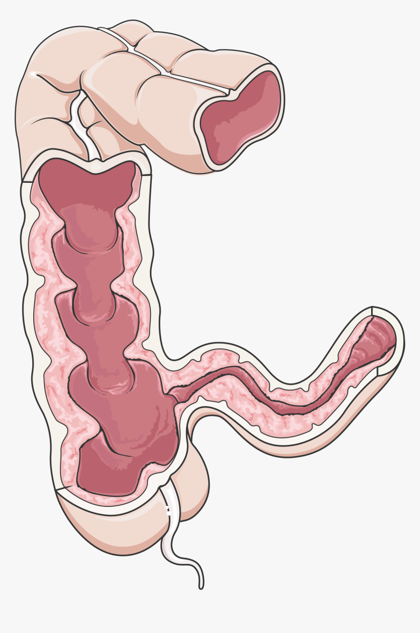 Crohn's Disease Png, Transparent Png