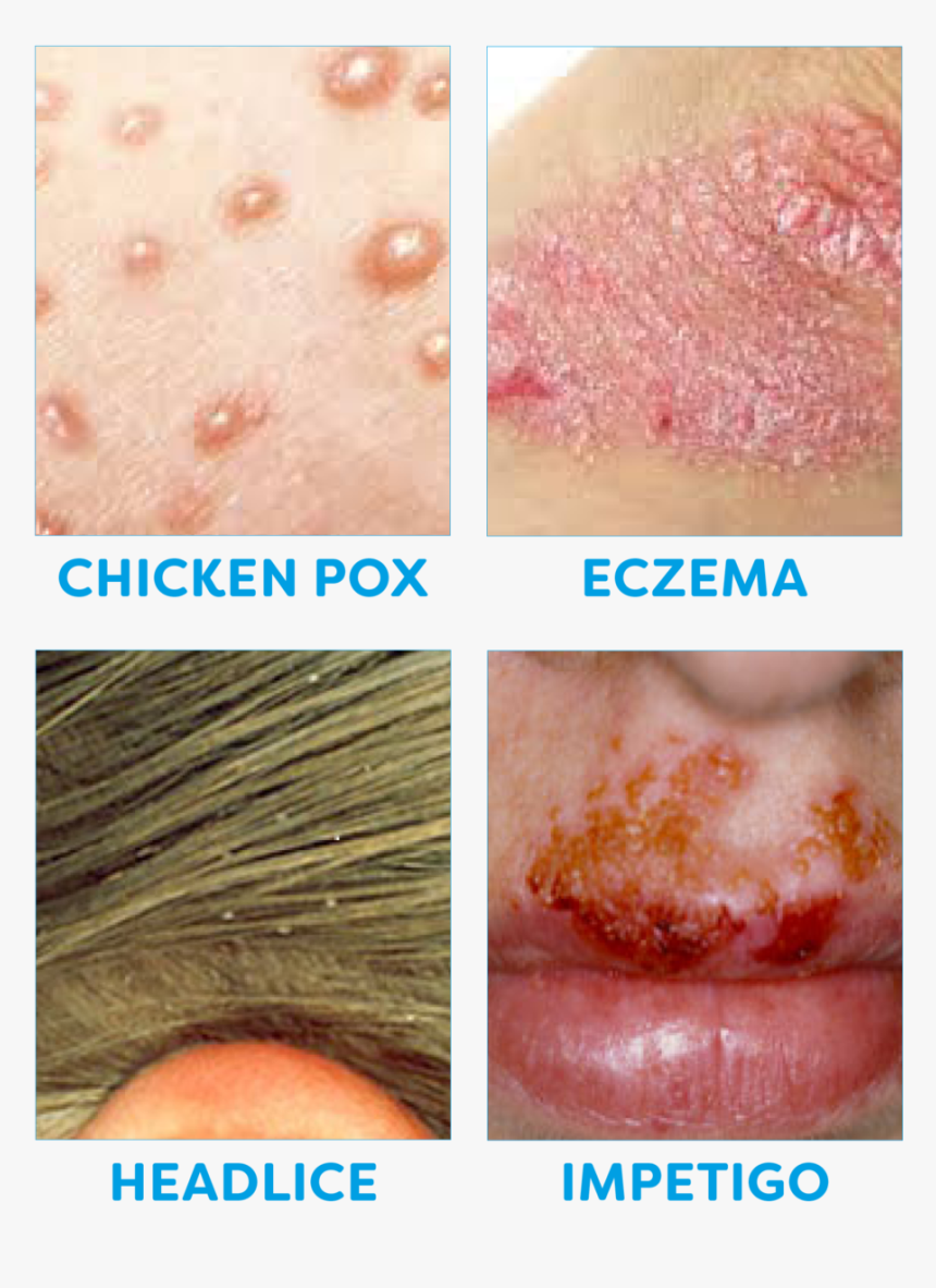Common Childhood Illnesses 2 - Meat, HD Png Download