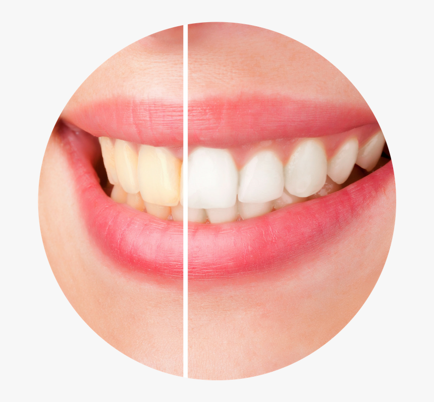 Before And After Teeth Whitening, HD Png Download