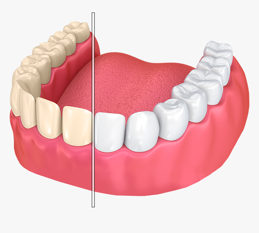 Illustration Of Before And After Whitening - Teeth Whitening Illustration, HD Png Download