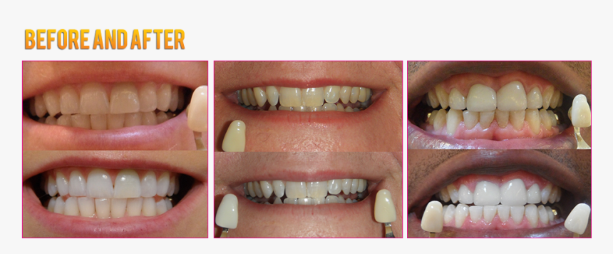 Led Teeth Whitening Coupons Led Teeth Whitening Before - Colorfulness, HD Png Download