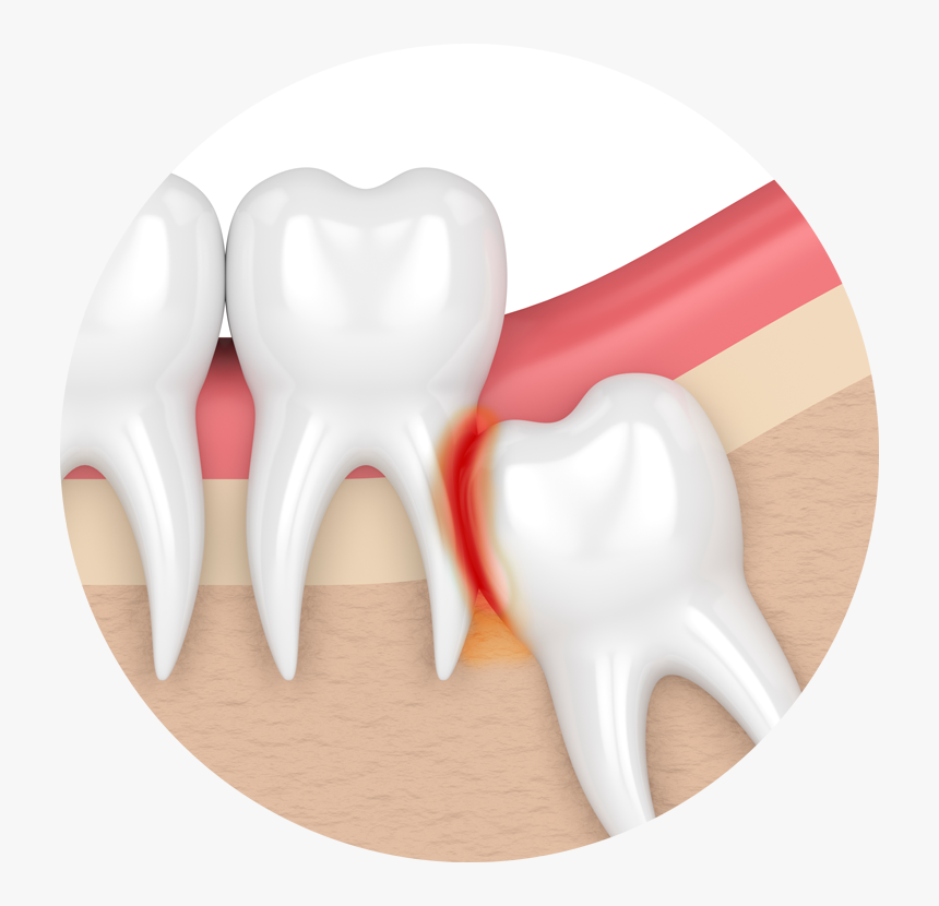 My Teeth Are Becoming Transparent Impaction Teeth Png - Impacted Wisdom Tooth, Png Download