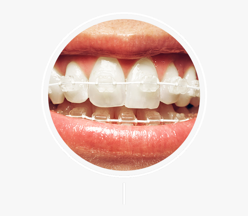 White And Silver Braces, HD Png Download
