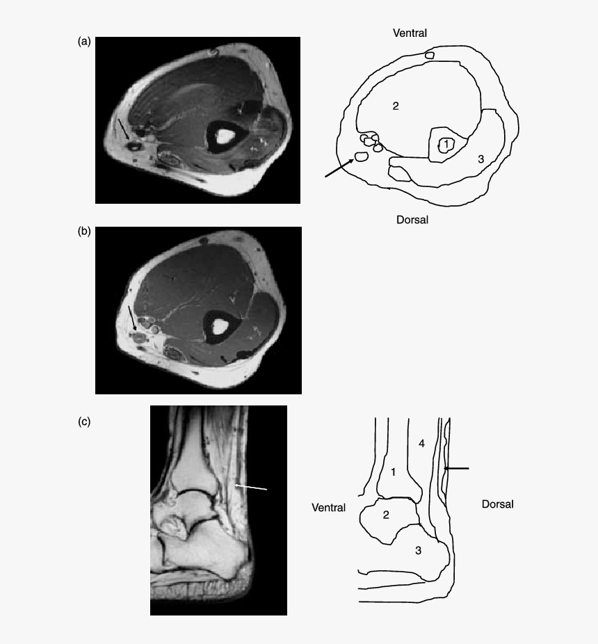 L Arm Mri Axial, HD Png Download