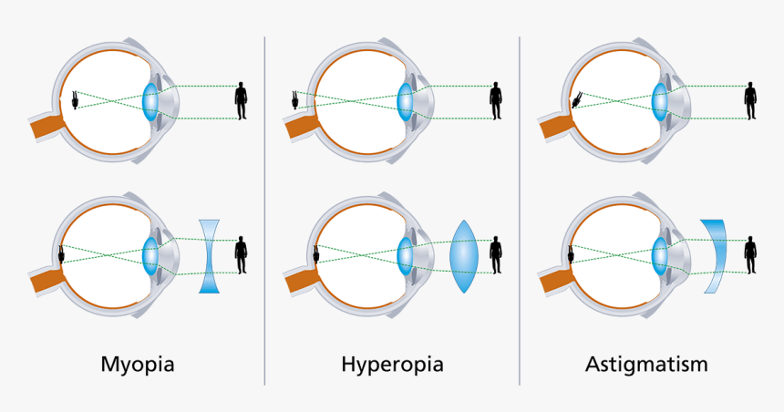 Presbiopia Nei Bambini Quando Preoccuparsi, HD Png Download