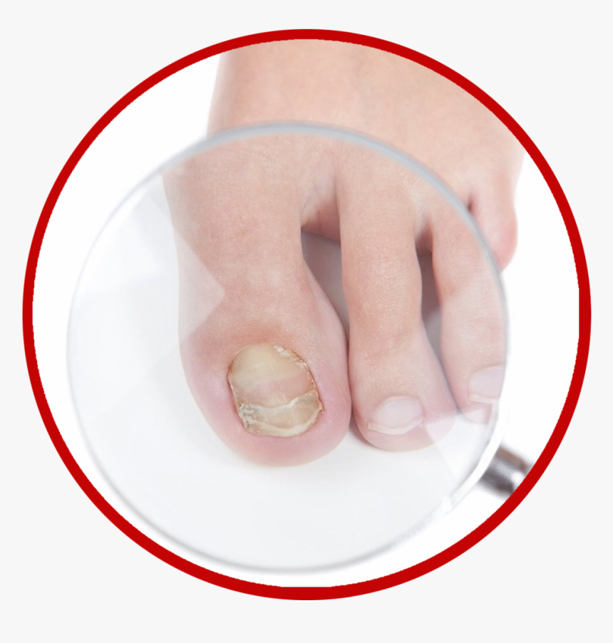 Fungus Png , Png Download - Remédio Caseiro Para Fungo Na Unha, Transparent Png