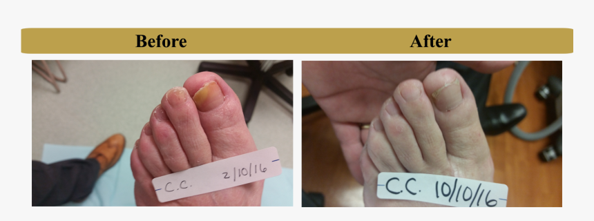 Tummy Tuck Scars After 1, HD Png Download