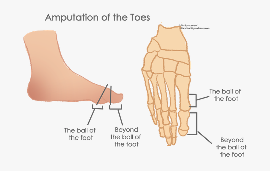 Transparent Toes Png - Partial Amputation Of Toe, Png Download