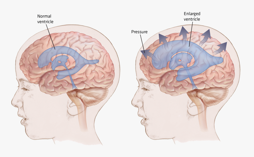 Null - Hydrocephalus Brain, HD Png Download