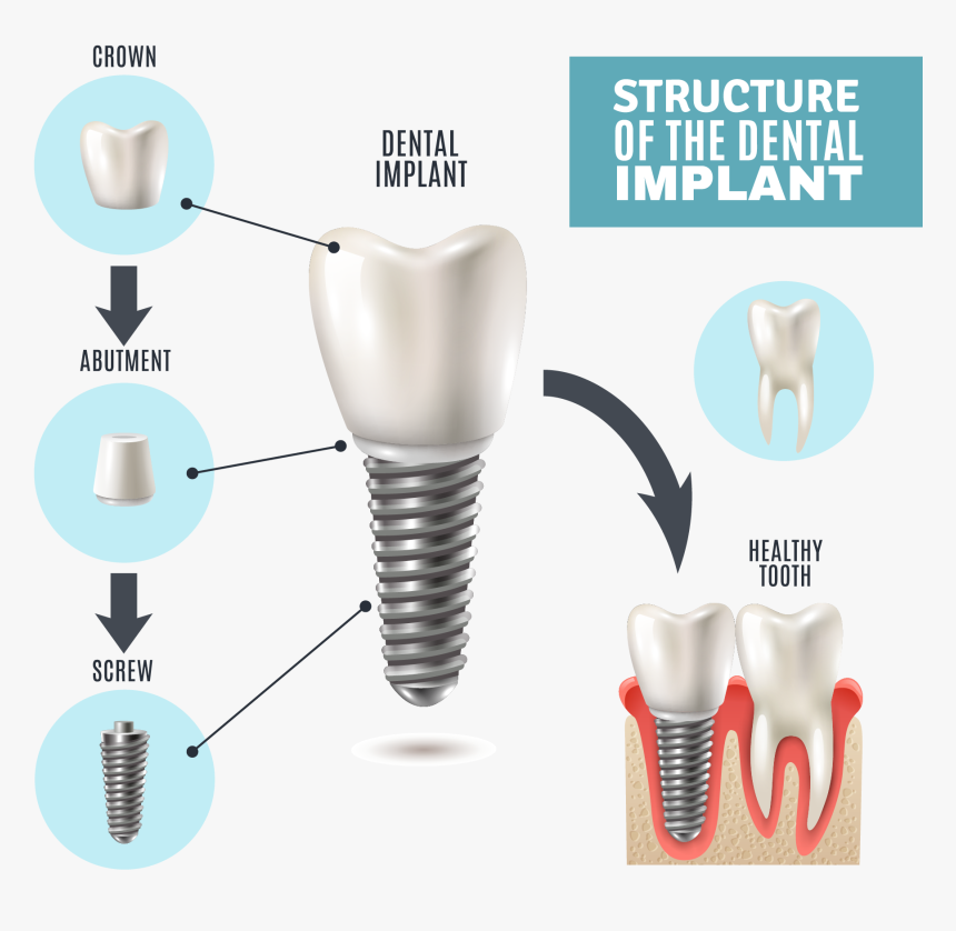 Part Of Dental Implant, HD Png Download