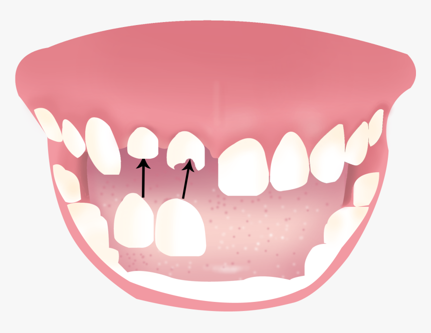 Dentures, HD Png Download