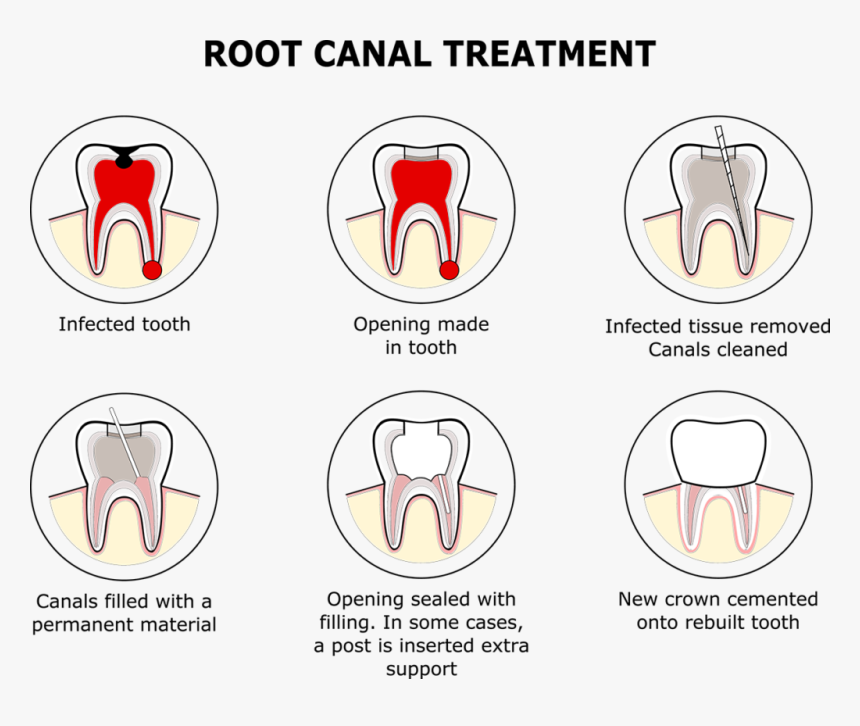 Root Canal Filling Replacement, HD Png Download