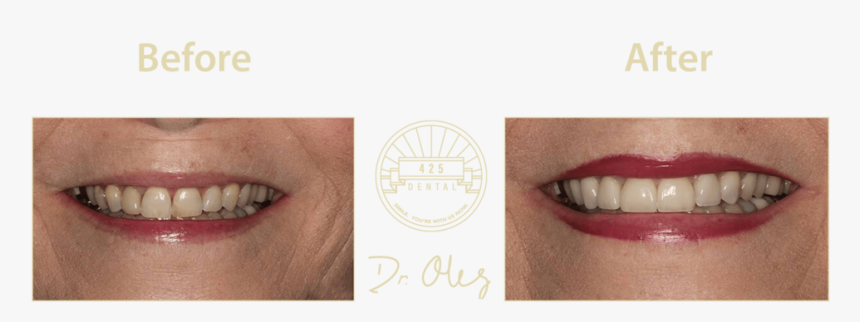 425 Before After Cosmetic34 - Portable Network Graphics, HD Png Download