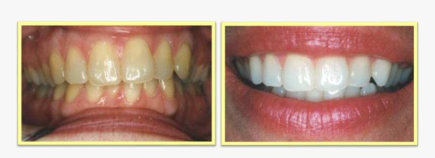 Cosmetic Dentistry, HD Png Download