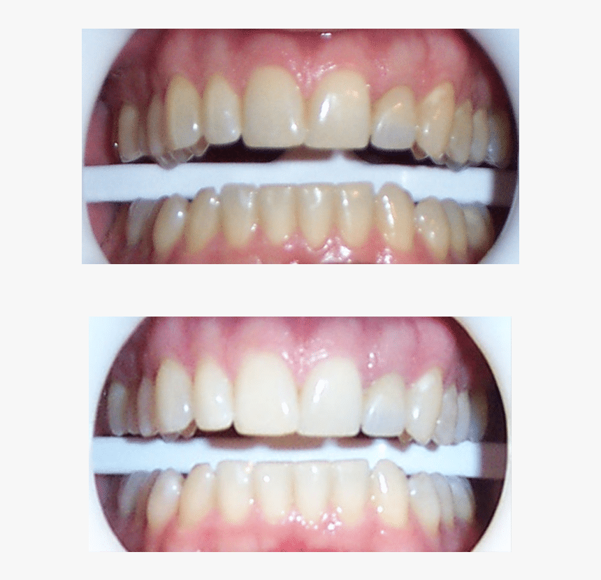 Austin Teeth Whitening - Zoom Whitening Before And After, HD Png