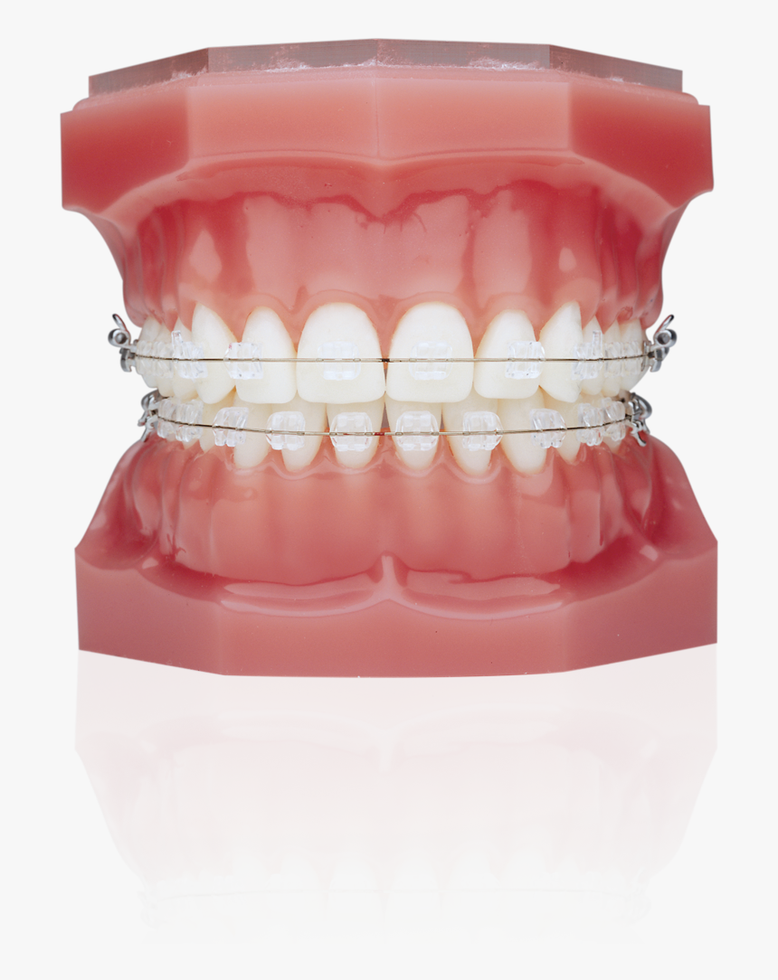 Ceramic Braces Vs Invisalign , Png Download - Ceramic Braces With Black Bands, Transparent Png