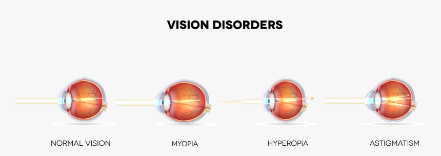 What Eye Conditions Does Lasik Treat Banner Personal Health