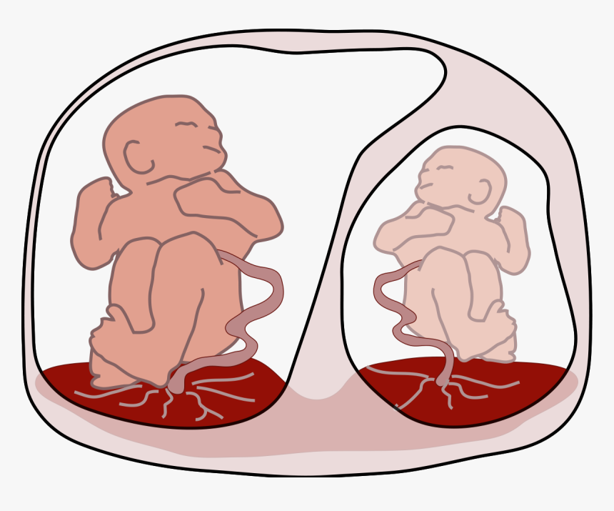 Sindrome De Transfusion Intergemelar, HD Png Download