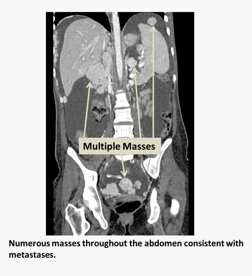 Metastatic - Types Of Matter, HD Png Download