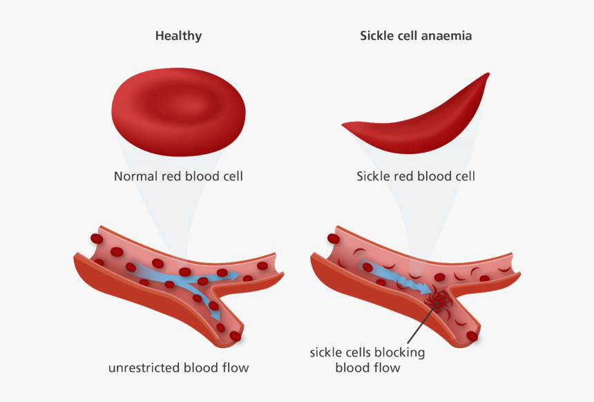Cotton Clipart White Blood Cell - Red Blood Cell Sickle Cell, HD Png ...