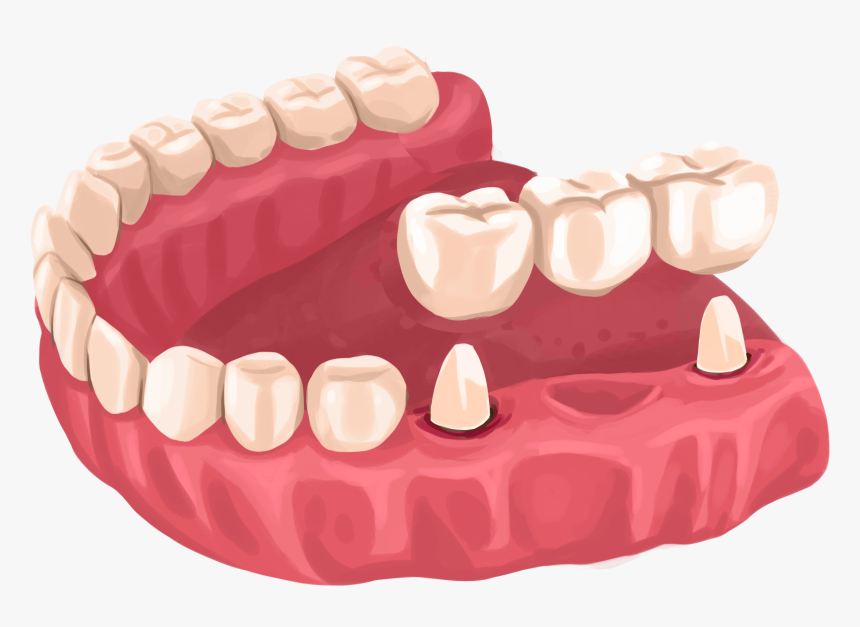 Dental Bridge Png, Transparent Png