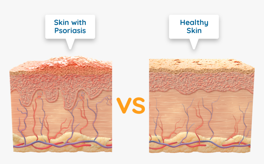 Diagram Of Skin With Psoriasis Vs Healthy Skin - Psoriasis Dead Skin Cell, HD Png Download